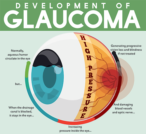 Development of Glaucoma Diagram