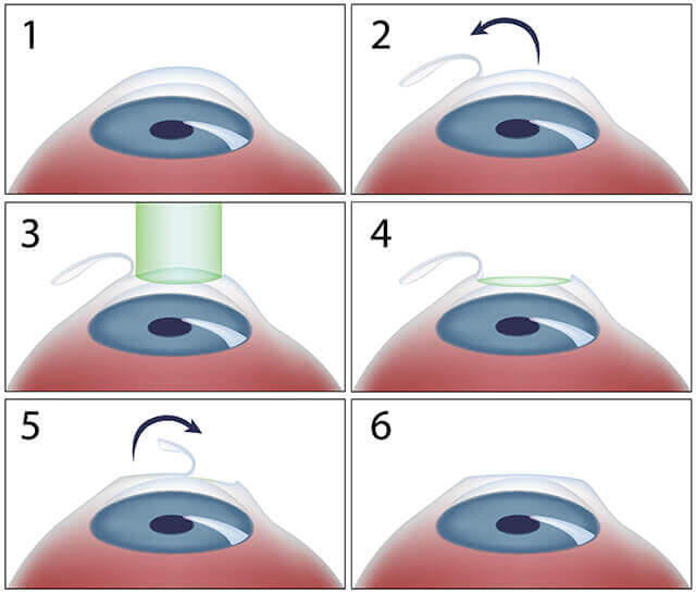 LASIK Steps Diagram